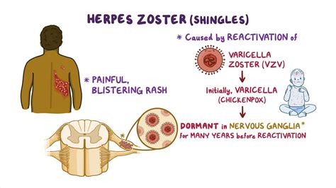 shingles dorsal root ganglion.